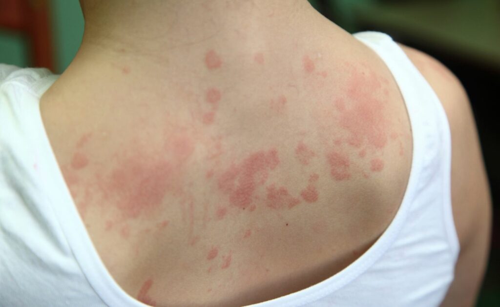 Allergische-Erkrankungen -Akne-Erding